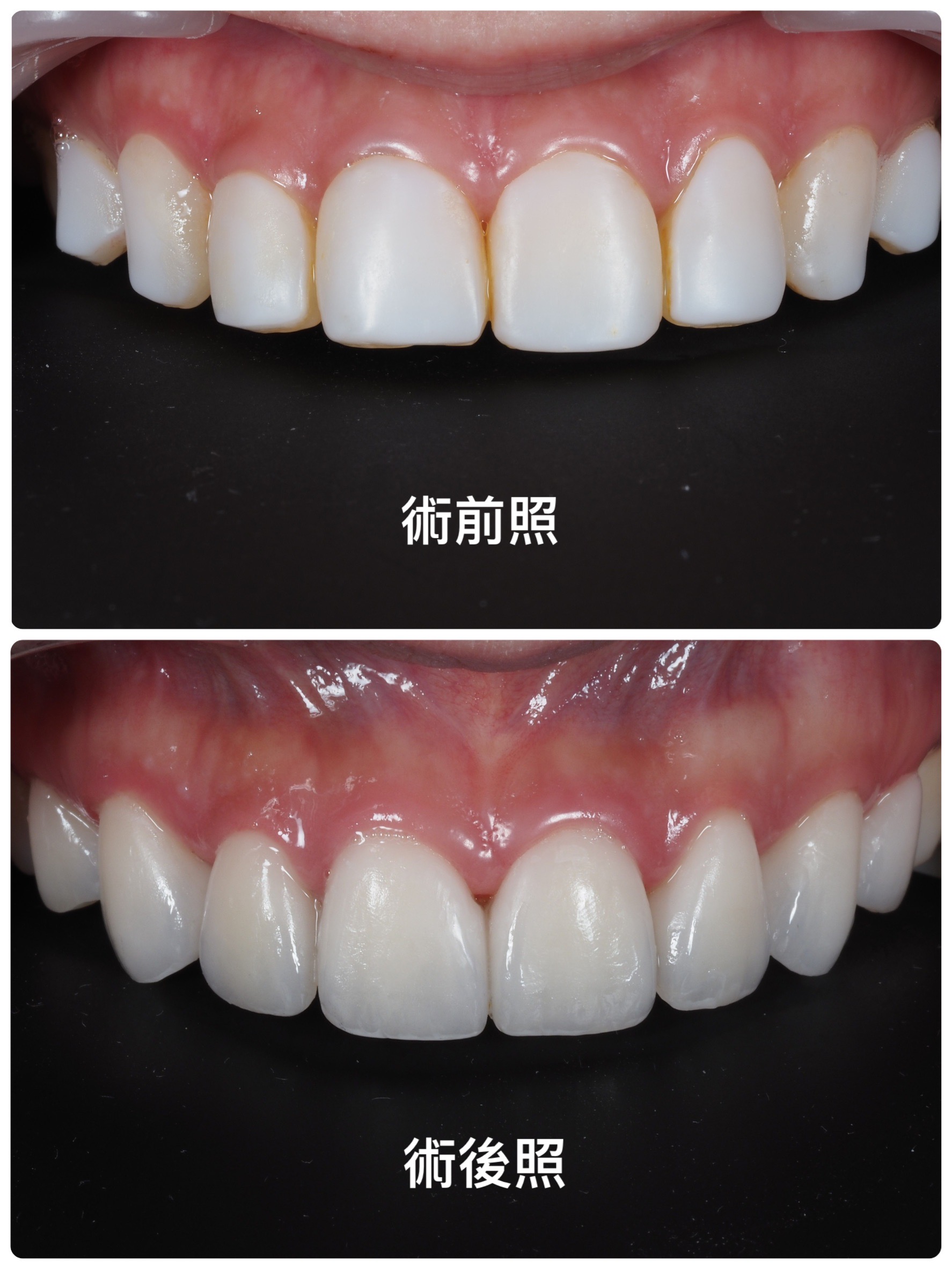 陶瓷貼片案例
